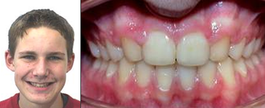 Nach Behandlung Zahnlücken Profil